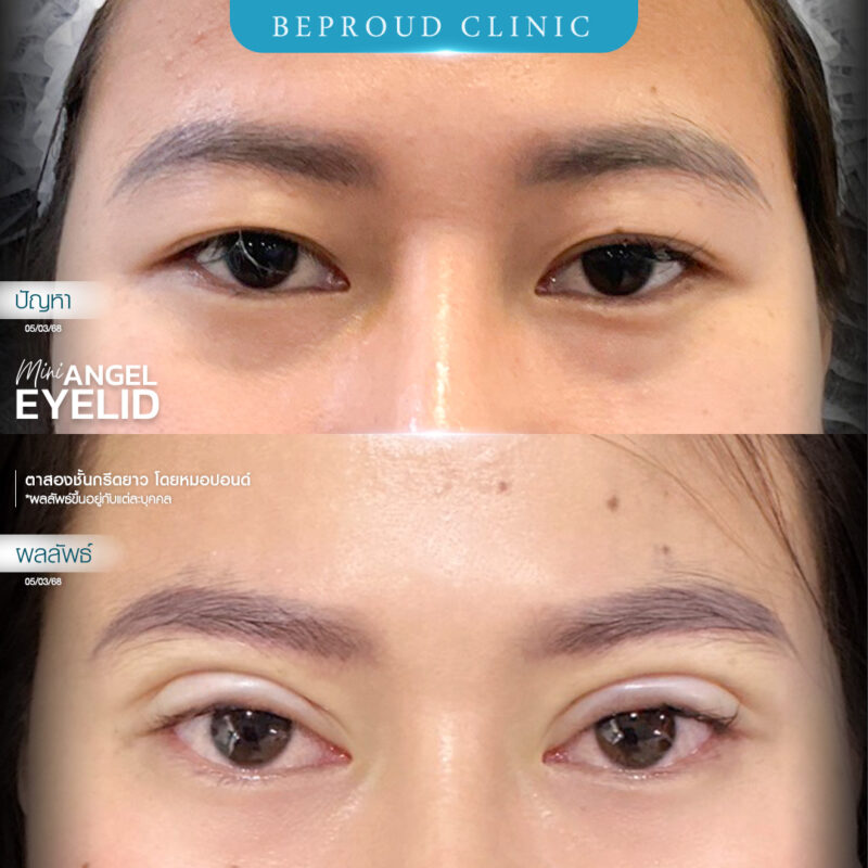 ภาพรีวิวเปรียบเทียบผลลัพธ์ ก่อนทำ-หลังทำศัลยกรรมตาสองชั้น ของเคสตัวอย่าง เทคนิคกรีดตายาว โดยหมอปอนด์ บีพราวด์คลินิก