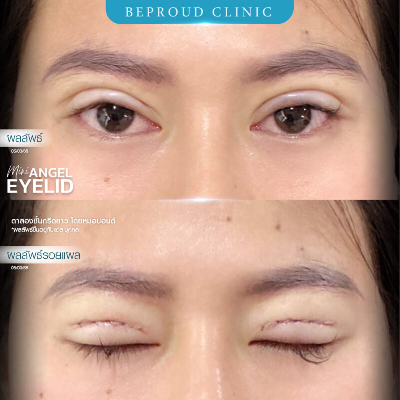 ภาพรีวิวเปรียบเทียบผลลัพธ์ ก่อนทำ-หลังทำศัลยกรรมตาสองชั้น ของเคสตัวอย่าง เทคนิคกรีดตายาว โดยหมอปอนด์ บีพราวด์คลินิก