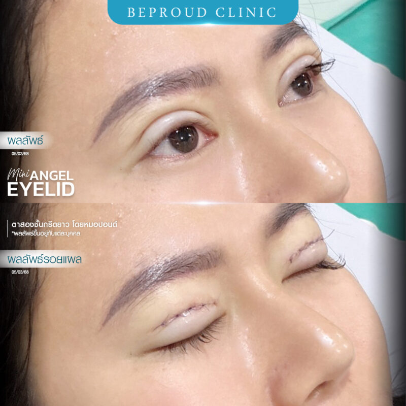 ภาพรีวิวเปรียบเทียบผลลัพธ์ ก่อนทำ-หลังทำศัลยกรรมตาสองชั้น ของเคสตัวอย่าง เทคนิคกรีดตายาว โดยหมอปอนด์ บีพราวด์คลินิก