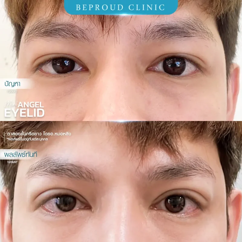 ภาพรีวิวเปรียบเทียบผลลัพธ์ ก่อนทำ-หลังทำศัลยกรรมตาสองชั้นผู้ชาย ของเคสตัวอย่าง เทคนิคกรีดยาว โดยอ.หมอหลิง บีพราวด์คลินิก