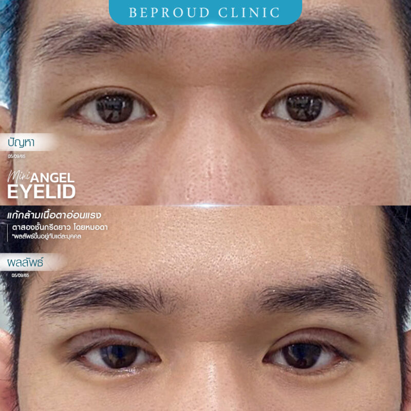 ภาพรีวิวเปรียบเทียบผลลัพธ์ ก่อนทำ-หลังทำศัลยกรรมตาสองชั้นผู้ชาย ของเคสตัวอย่าง เทคนิคกรีดตายาว แก้กล้ามเนื้อตาอ่อนแรง โดยหมอดา บีพราวด์คลินิก