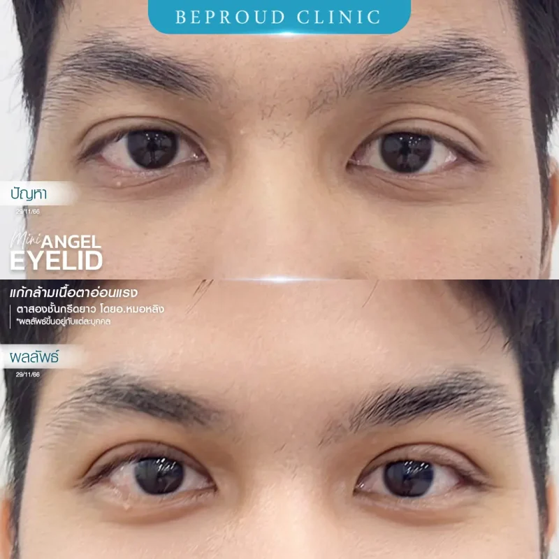ภาพรีวิวเปรียบเทียบผลลัพธ์ ก่อนทำ-หลังทำศัลยกรรมตาสองชั้นผู้ชาย ของเคสตัวอย่าง เทคนิคกรีดตายาว แก้กล้ามเนื้อตาอ่อนแรง โดยอ.หมอหลิง บีพราวด์คลินิก