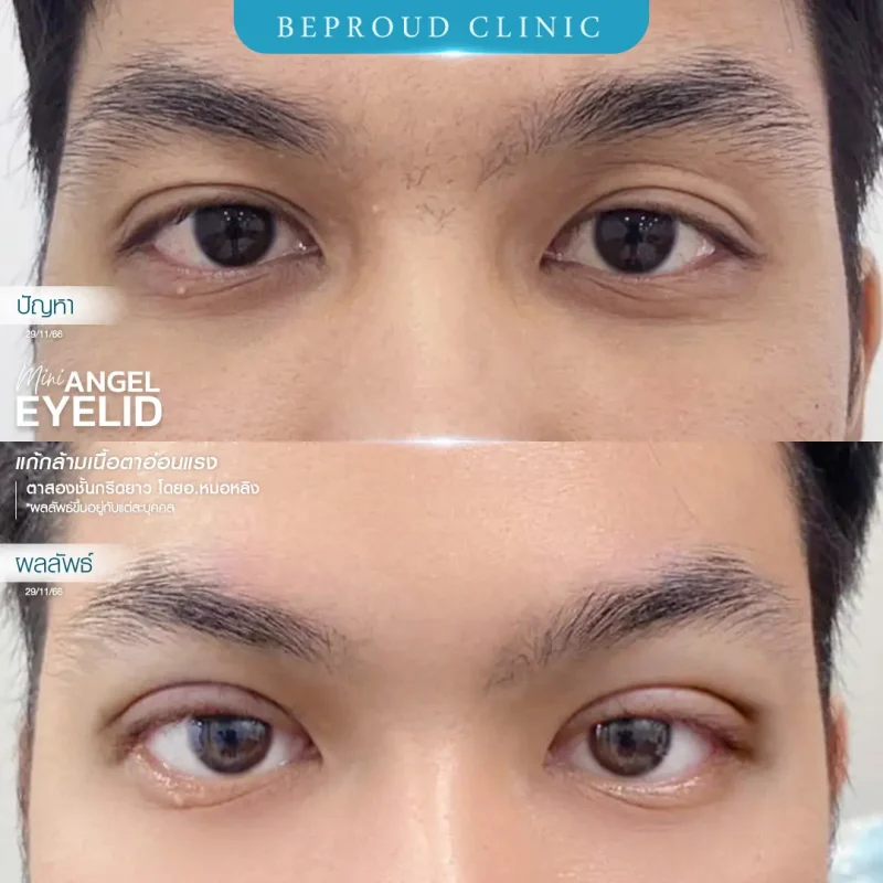 ภาพรีวิวเปรียบเทียบผลลัพธ์ ก่อนทำ-หลังทำศัลยกรรมตาสองชั้นผู้ชาย ของเคสตัวอย่าง เทคนิคกรีดตายาว แก้กล้ามเนื้อตาอ่อนแรง โดยอ.หมอหลิง บีพราวด์คลินิก