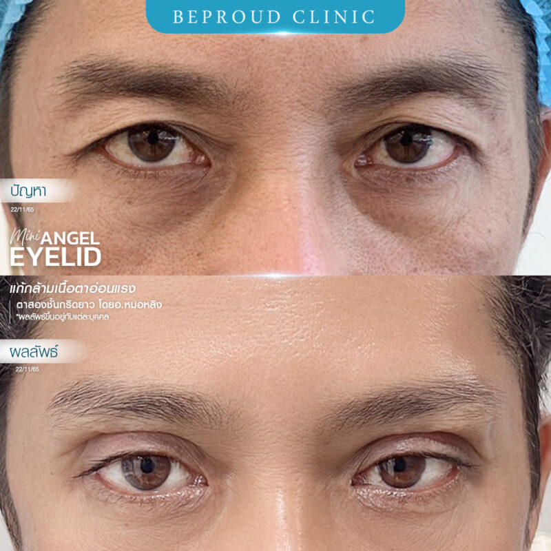 ภาพรีวิวเปรียบเทียบผลลัพธ์ ก่อนทำ-หลังทำศัลยกรรมตาสองชั้นผู้ชาย ของเคสตัวอย่าง เทคนิคกรีดตายาว แก้กล้ามเนื้อตาอ่อนแรง โดยอ.หมอหลิง บีพราวด์คลินิก