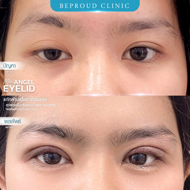 ภาพรีวิวเปรียบเทียบผลลัพธ์ ก่อนทำ-หลังทำศัลยกรรมตาสองชั้น ของเคสตัวอย่าง เทคนิคกรีดตายาว แก้กล้ามเนื้อตาอ่อนแรง โดยอ.หมอหลิง บีพราวด์คลินิก