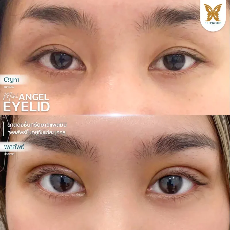 ภาพรีวิวเปรียบเทียบผลลัพธ์ ก่อนทำ-หลังทำศัลยกรรมตาสองชั้น ของเคสตัวอย่าง เทคนิคกรีดยาวแผลมินิ โดยหมอจู บีพราวด์คลินิก