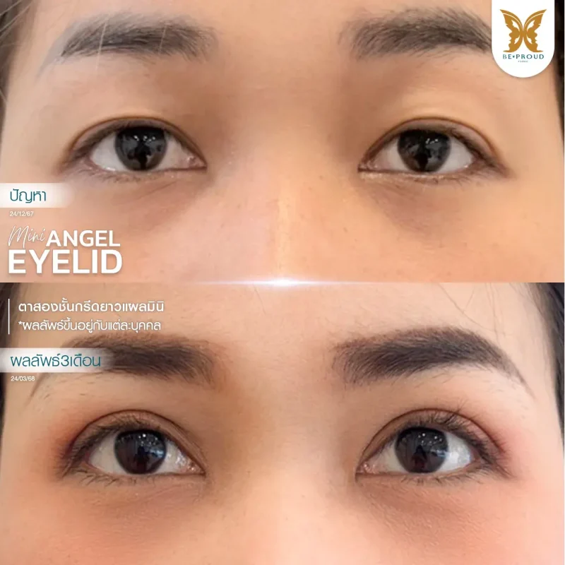 ภาพรีวิวเปรียบเทียบผลลัพธ์ ก่อนทำ-หลังทำศัลยกรรมตาสองชั้น ของเคสตัวอย่าง เทคนิคกรีดยาวแผลมินิ โดยหมอจู บีพราวด์คลินิก