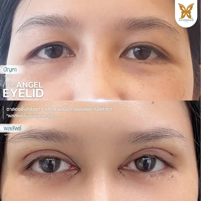 ภาพรีวิวเปรียบเทียบผลลัพธ์ ก่อนทำ-หลังทำศัลยกรรมตาสองชั้น ของเคสตัวอย่าง เทคนิคกรีดตายาว แก้กล้ามเนื้อตาอ่อนแรง เปิดหัวตา โดยหมอจู บีพราวด์คลินิก