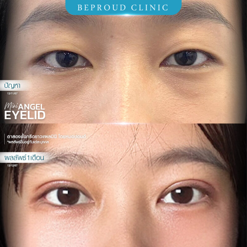 ภาพรีวิวเปรียบเทียบผลลัพธ์ ก่อนทำ-หลังทำศัลยกรรมตาสองชั้น ของเคสตัวอย่าง เทคนิคกรีดตายาวแผลมิน โดยหมอปอนด์ บีพราวด์คลินิก