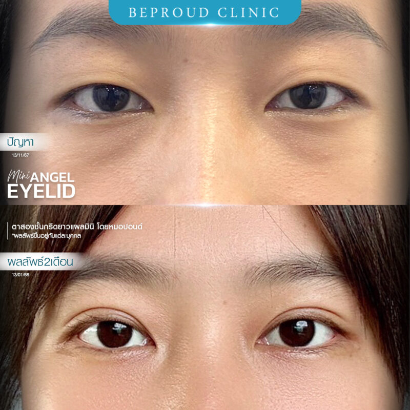 ภาพรีวิวเปรียบเทียบผลลัพธ์ ก่อนทำ-หลังทำศัลยกรรมตาสองชั้น ของเคสตัวอย่าง เทคนิคกรีดตายาวแผลมิน โดยหมอปอนด์ บีพราวด์คลินิก