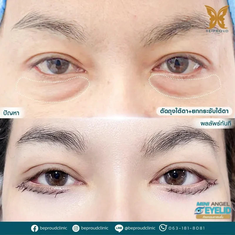 ภาพรีวิวเปรียบเทียบผลลัพธ์ ก่อนทำ-หลังทำศัลยกรรมตัดถุงใต้ตา ยกกระชับใต้ตา โดยหมอดา บีพราวด์คลินิก