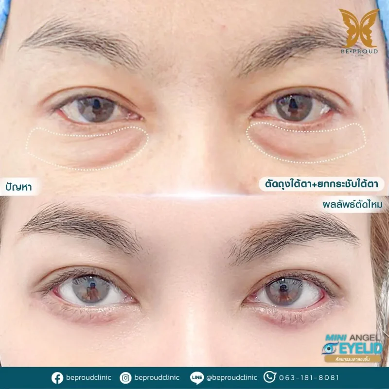 ภาพรีวิวเปรียบเทียบผลลัพธ์ ก่อนทำ-หลังทำศัลยกรรมตัดถุงใต้ตา ยกกระชับใต้ตา โดยหมอดา บีพราวด์คลินิก
