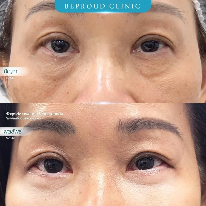 ภาพรีวิวเปรียบเทียบผลลัพธ์ ก่อนทำ-หลังทำศัลยกรรมตัดถุงใต้ตาแผลนอก โดยอ.หมอหลิง บีพราวด์คลินิก