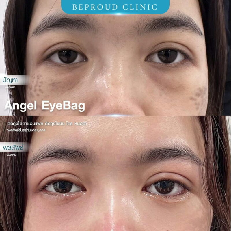 ภาพรีวิวเปรียบเทียบผลลัพธ์ ก่อนทำ-หลังทำศัลยกรรมตัดถุงใต้ตาซ่อนแผล ตัดถุงไขมัน โดยหมอดา บีพราวด์คลินิก