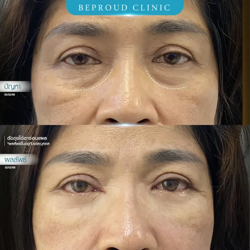 ภาพรีวิวเปรียบเทียบผลลัพธ์ ก่อนทำ-หลังทำศัลยกรรมตัดถุงใต้ตาซ่อนแผล โดยหมอต้น บีพราวด์คลินิก