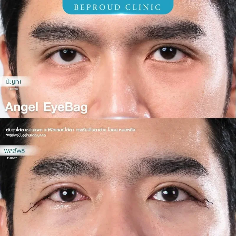 ภาพรีวิวเปรียบเทียบผลลัพธ์ ก่อนทำ-หลังทำศัลยกรรมตัดถุงใต้ตาซ่อนแผล แก้ฟิลเลอร์ใต้ตา กระชับเอ็นตาล่าง โดยอ.หมอหลิง บีพราวด์คลินิก