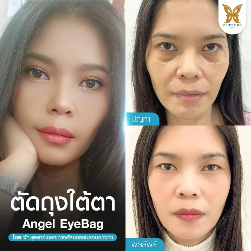 ภาพรีวิวเปรียบเทียบผลลัพธ์ ก่อนทำ-หลังทำศัลยกรรมตัดถุงใต้ตา โดยอ.หมอหลิง บีพราวด์คลินิก