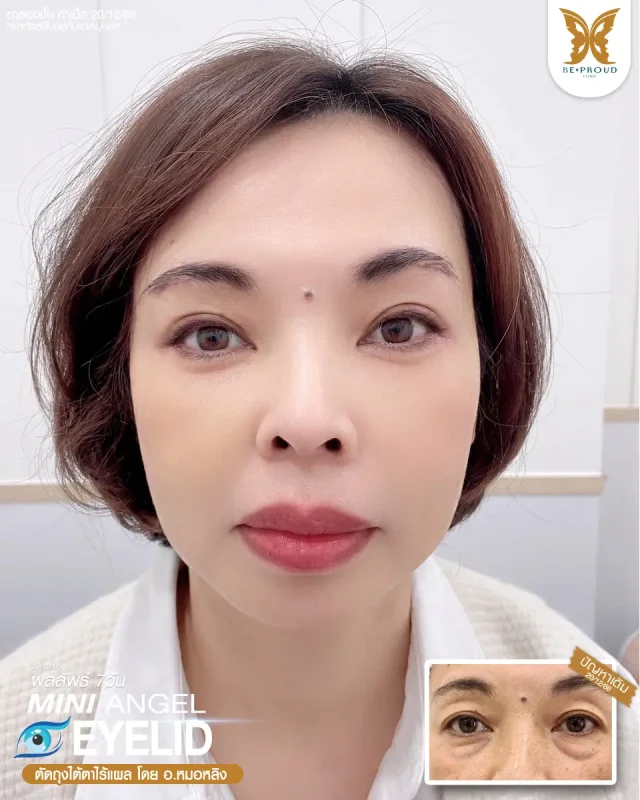 ภาพรีวิวคนสวย ตาสองชั้นกรีดยาว ตัดถุงใต้ตาไร้แผล โดย อ.หมอหลิง (พญ.กัญญ์ชิสา) บีพราวด์คลินิก แสดงผลลัพธ์ ชั้นตาสวยคมชัด ดวงตาดูสดใส