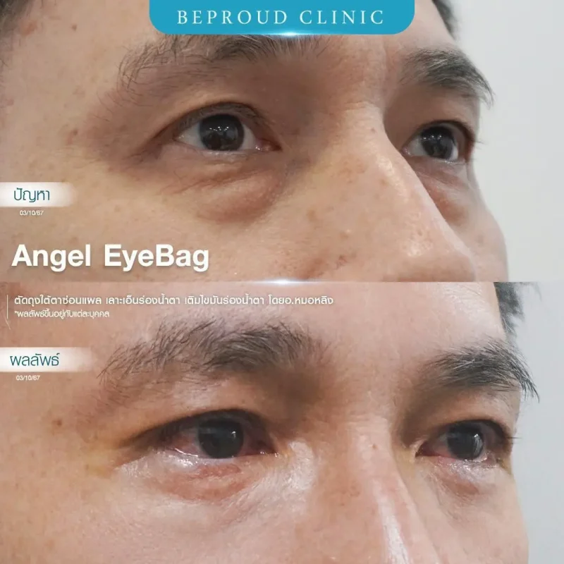 ภาพรีวิวเปรียบเทียบผลลัพธ์ ก่อนทำ-หลังทำศัลยกรรมตัดถุงใต้ตาซ่อนแผล เลาะเอ็นร่องน้ำตา เติมไขมันร่องน้ำตา โดยอ.หมอหลิง บีพราวด์คลินิก