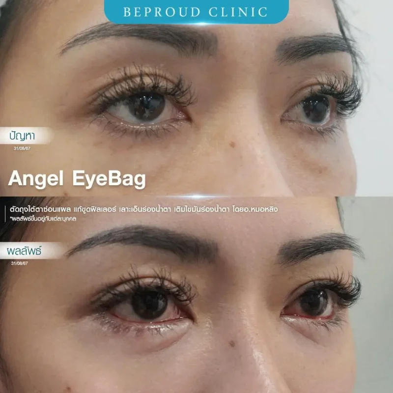 ภาพรีวิวเปรียบเทียบผลลัพธ์ ก่อนทำ-หลังทำศัลยกรรมตัดถุงใต้ตาซ่อนแผล แก้ขูดฟิลเลอร์ เลาะเอ็นร่องน้ำตา เติมไขมันร่องน้ำตา โดยอ.หมอหลิง บีพราวด์คลินิก