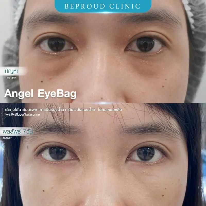 ภาพรีวิวเปรียบเทียบผลลัพธ์ ก่อนทำ-หลังทำศัลยกรรมตัดถุงใต้ตาซ่อนแผล เลาะเอ็นร่องน้ำตา เติมไขมันร่องน้ำตา โดยอ.หมอหลิง บีพราวด์คลินิก