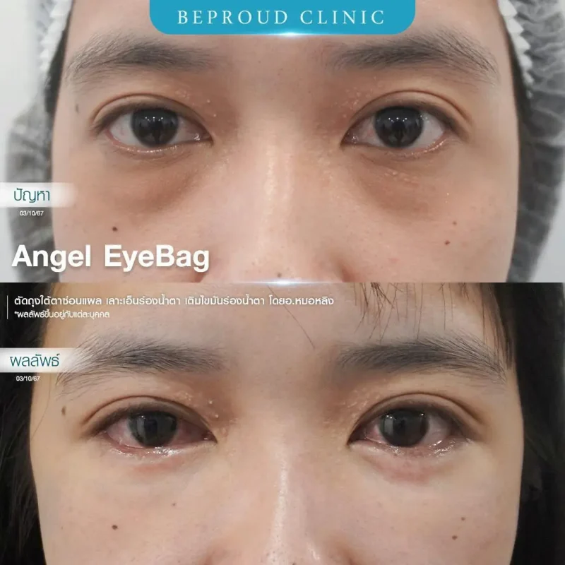 ภาพรีวิวเปรียบเทียบผลลัพธ์ ก่อนทำ-หลังทำศัลยกรรมตัดถุงใต้ตาซ่อนแผล เลาะเอ็นร่องน้ำตา เติมไขมันร่องน้ำตา โดยอ.หมอหลิง บีพราวด์คลินิก