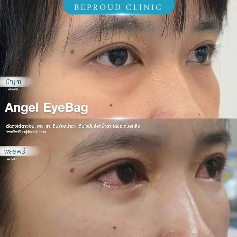 ภาพรีวิวเปรียบเทียบผลลัพธ์ ก่อนทำ-หลังทำศัลยกรรมตัดถุงใต้ตาซ่อนแผล เลาะเอ็นร่องน้ำตา เติมไขมันร่องน้ำตา โดยอ.หมอหลิง บีพราวด์คลินิก