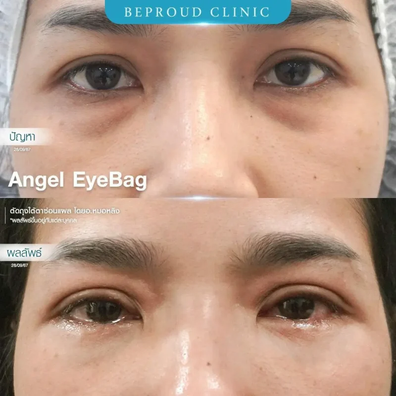 ภาพรีวิวเปรียบเทียบผลลัพธ์ ก่อนทำ-หลังทำศัลยกรรมตัดถุงใต้ตาซ่อนแผล โดยอ.หมอหลิง บีพราวด์คลินิก