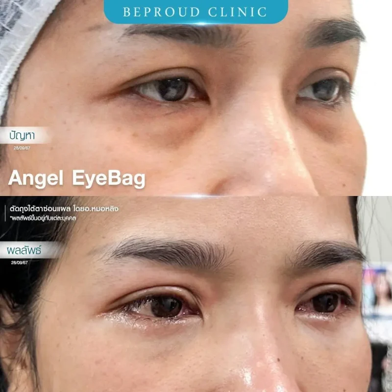 ภาพรีวิวเปรียบเทียบผลลัพธ์ ก่อนทำ-หลังทำศัลยกรรมตัดถุงใต้ตาซ่อนแผล โดยอ.หมอหลิง บีพราวด์คลินิก