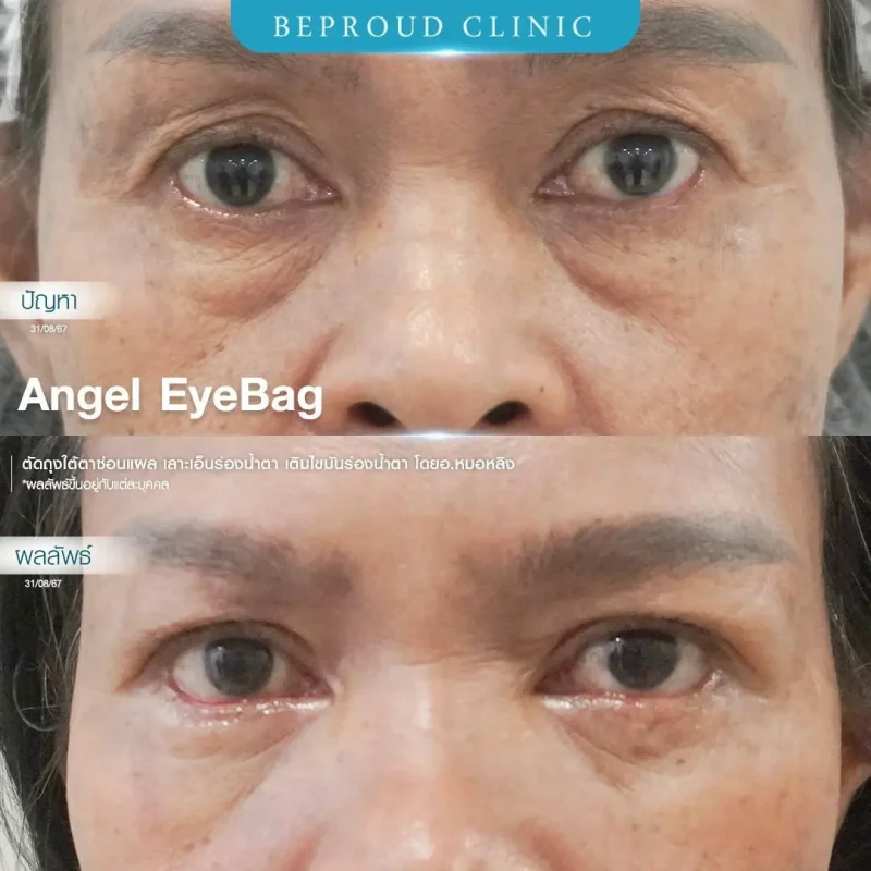 ภาพรีวิวเปรียบเทียบผลลัพธ์ ก่อนทำ-หลังทำศัลยกรรมตัดถุงใต้ตาซ่อนแผล เลาะเอ็นร่องน้ำตา เติมไขมันร่องน้ำตา โดยอ.หมอหลิง บีพราวด์คลินิก