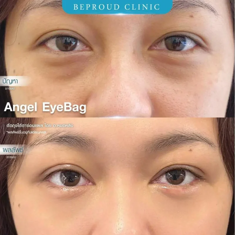 ภาพรีวิวเปรียบเทียบผลลัพธ์ ก่อนทำ-หลังทำศัลยกรรมตัดถุงใต้ตาซ่อนแผล โดยอ.หมอหลิง บีพราวด์คลินิก