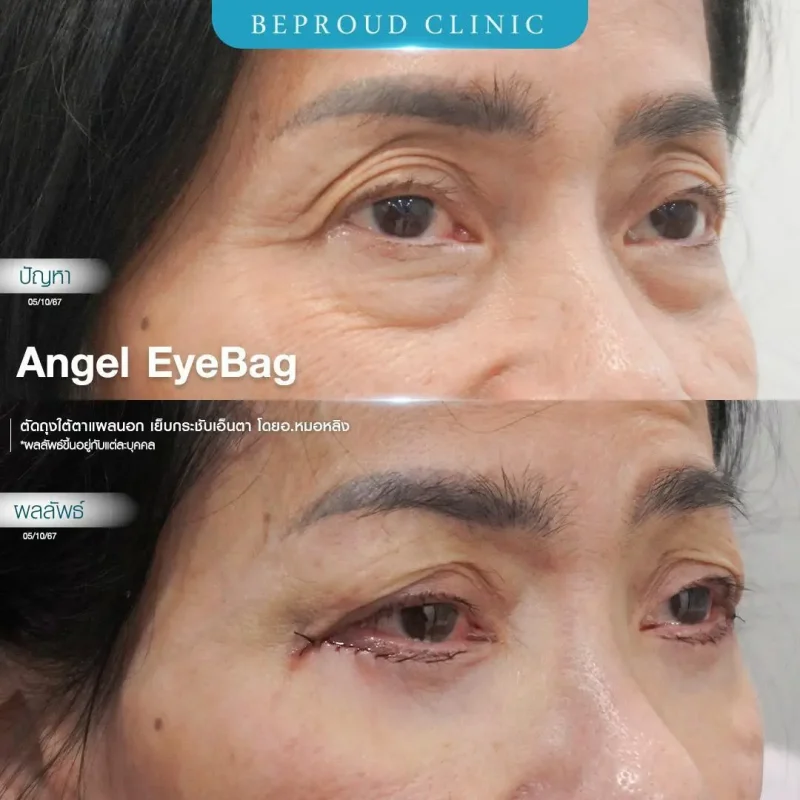 ภาพรีวิวเปรียบเทียบผลลัพธ์ ก่อนทำ-หลังทำศัลยกรรมตัดถุงใต้ตาแผลนอก เย็บกระชับเอ็นตา โดยอ.หมอหลิง บีพราวด์คลินิก