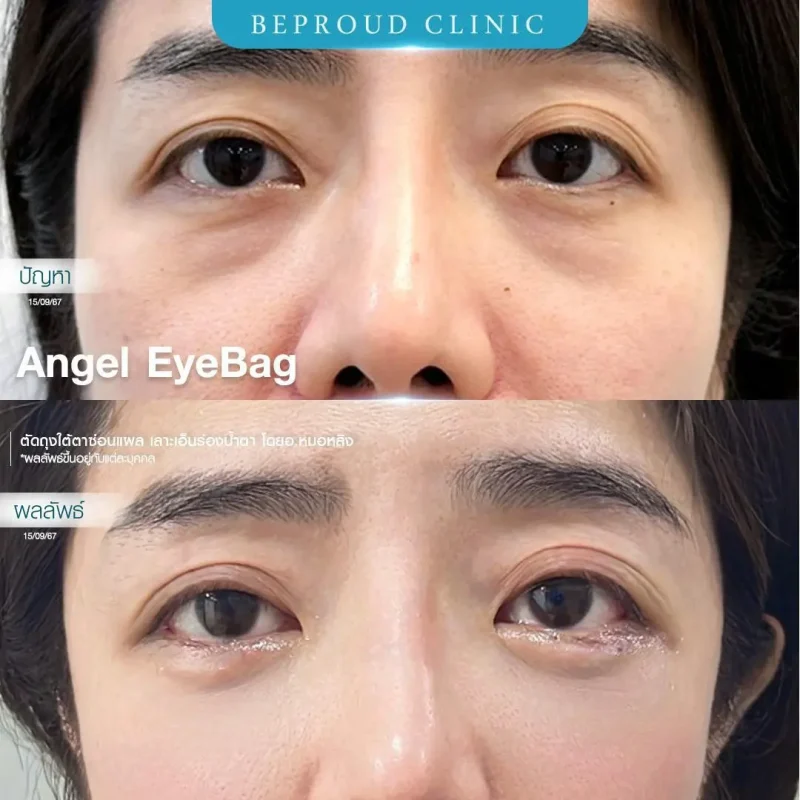 ภาพรีวิวเปรียบเทียบผลลัพธ์ ก่อนทำ-หลังทำศัลยกรรมตัดถุงใต้ตาซ่อนแผล เลาะเอ็นร่องน้ำตา โดยอ.หมอหลิง บีพราวด์คลินิก