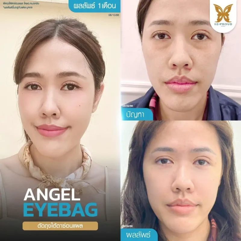 ภาพรีวิวเปรียบเทียบผลลัพธ์ ก่อนทำ-หลังทำศัลยกรรมตัดถุงใต้ตาซ่อนแผล โดยอ.หมอหลิง บีพราวด์คลินิก