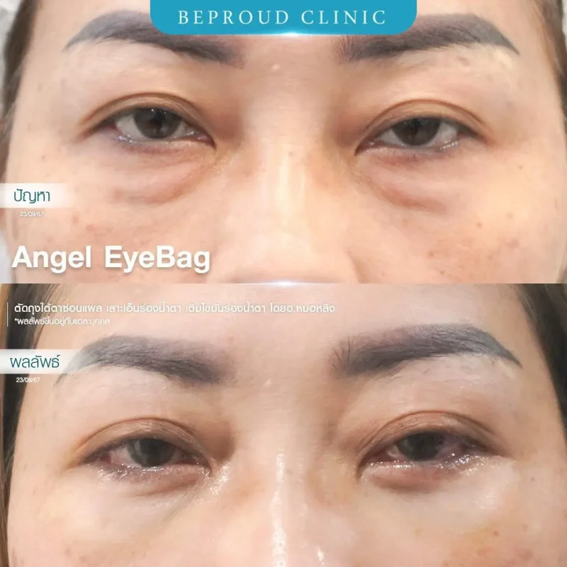 ภาพรีวิวเปรียบเทียบผลลัพธ์ ก่อนทำ-หลังทำศัลยกรรมตัดถุงใต้ตาซ่อนแผล เลาะเอ็นร่องน้ำตา เติมไขมันร่องน้ำตา โดยอ.หมอหลิง บีพราวด์คลินิก