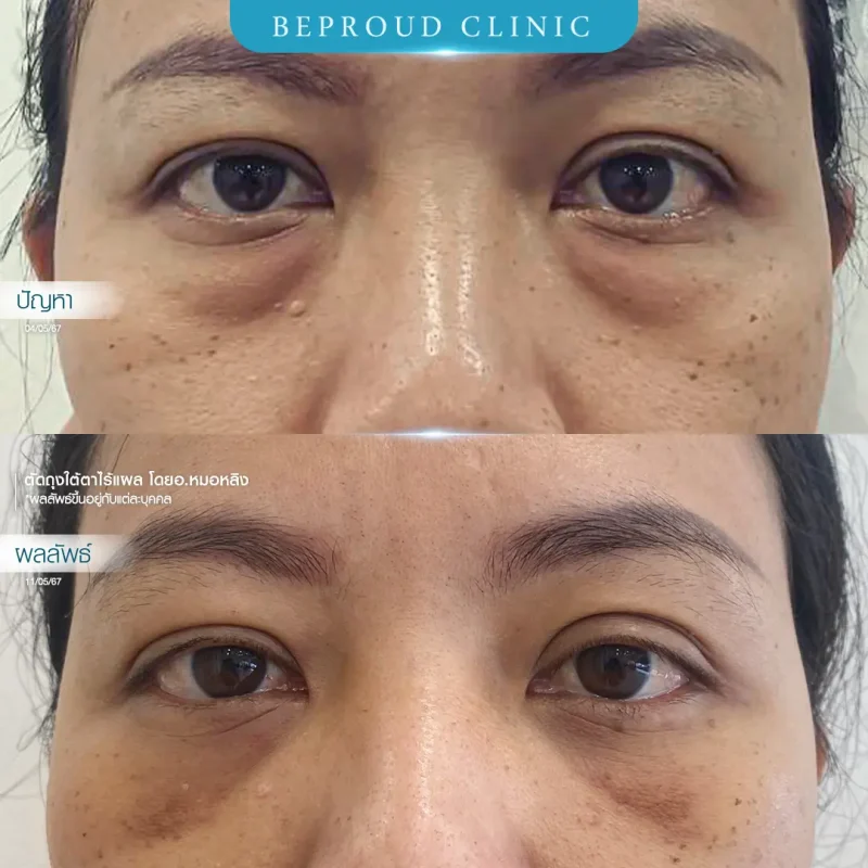 ภาพรีวิวเปรียบเทียบผลลัพธ์ ก่อนทำ-หลังทำศัลยกรรมตัดถุงใต้ตาไร้แผล โดยอ.หมอหลิง บีพราวด์คลินิก