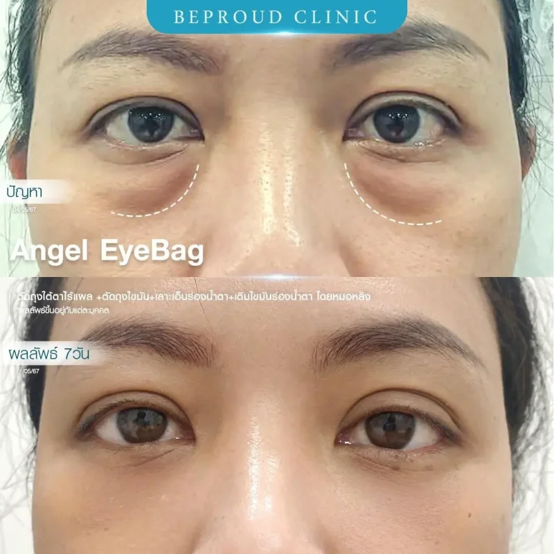 ภาพรีวิวเปรียบเทียบผลลัพธ์ ก่อนทำ-หลังทำศัลยกรรมตัดถุงใต้ตาไร้แผล ตัดถุงไขมัน เลาะเอ็นร่องน้ำตา เติมไขมันร่องน้ำตา โดยอ.หมอหลิง บีพราวด์คลินิก