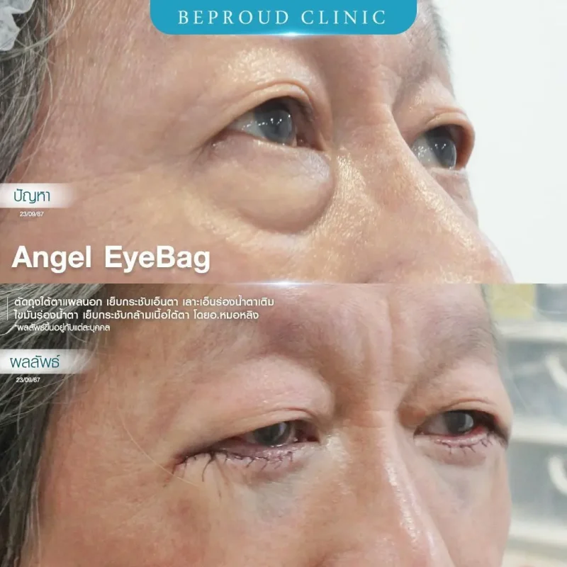 ภาพรีวิวเปรียบเทียบผลลัพธ์ ก่อนทำ-หลังทำศัลยกรรมตัดถุงใต้ตาแผลนอก เย็บกระชับเอ็นตา เลาะเอ็นร่องน้ำตา เติมไขมันร่องน้ำตา เย็บกระชับกล้ามเนื้อใต้ตา โดยอ.หมอหลิง บีพราวด์คลินิก