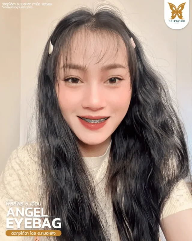 ภาพรีวิวคนสวย ตัดถุงใต้ตาแผลใน ตัดถุงไขมัน เติมไขมันร่องน้ำตา เลาะเอ็นร่องน้ำตา โดย อ.หมอหลิง (พญ.กัญญ์ชิสา) บีพราวด์คลินิก แสดงผลลัพธ์ ชั้นตาสวยคมชัด ดวงตาดูสดใส