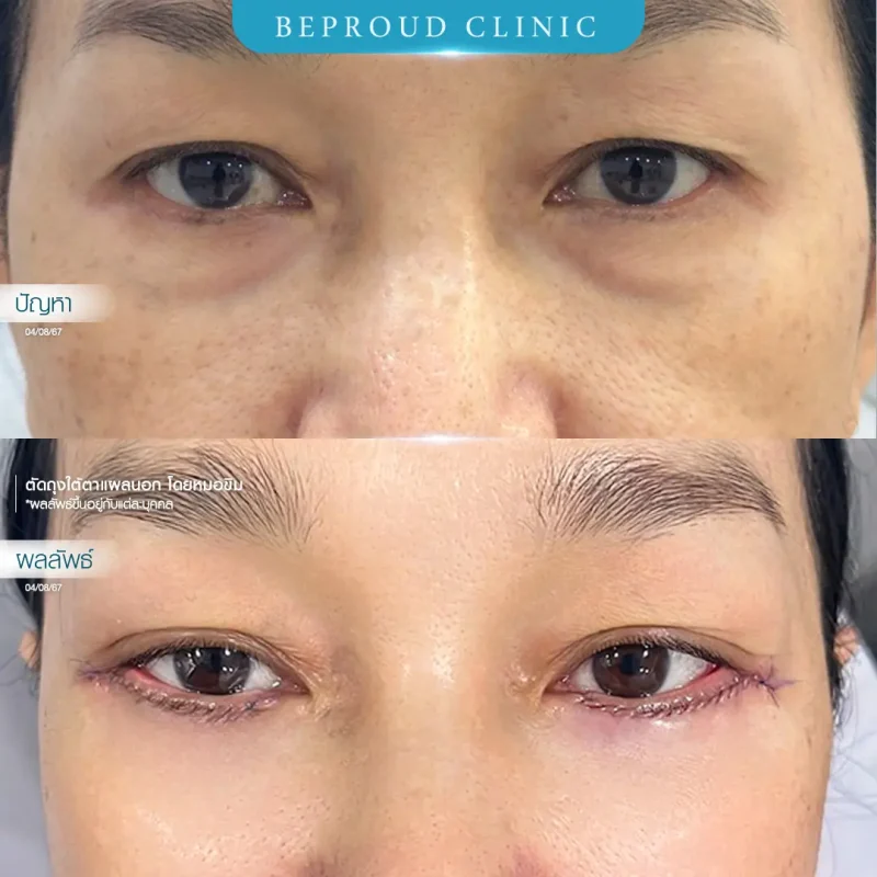 ภาพรีวิวเปรียบเทียบผลลัพธ์ ก่อนทำ-หลังทำศัลยกรรมตัดถุงใต้ตาแผลนอก โดยหมอขิม บีพราวด์คลินิก