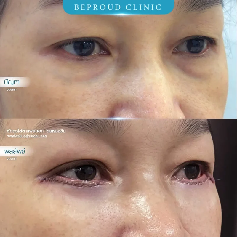 ภาพรีวิวเปรียบเทียบผลลัพธ์ ก่อนทำ-หลังทำศัลยกรรมตัดถุงใต้ตาแผลนอก โดยหมอขิม บีพราวด์คลินิก