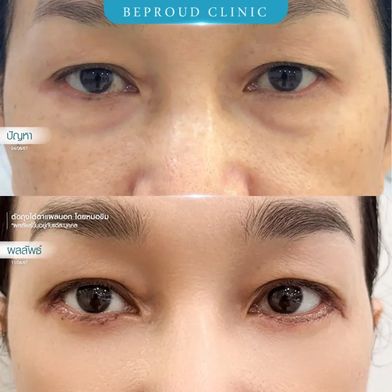 ภาพรีวิวเปรียบเทียบผลลัพธ์ ก่อนทำ-หลังทำศัลยกรรมตัดถุงใต้ตาแผลนอก โดยหมอขิม บีพราวด์คลินิก