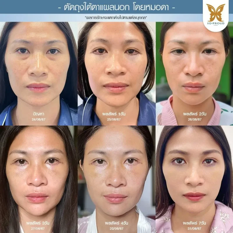 ภาพรีวิวเปรียบเทียบผลลัพธ์ ก่อนทำ-หลังทำศัลยกรรมตัดถุงใต้ตาแผลนอก โดยหมอดา บีพราวด์คลินิก