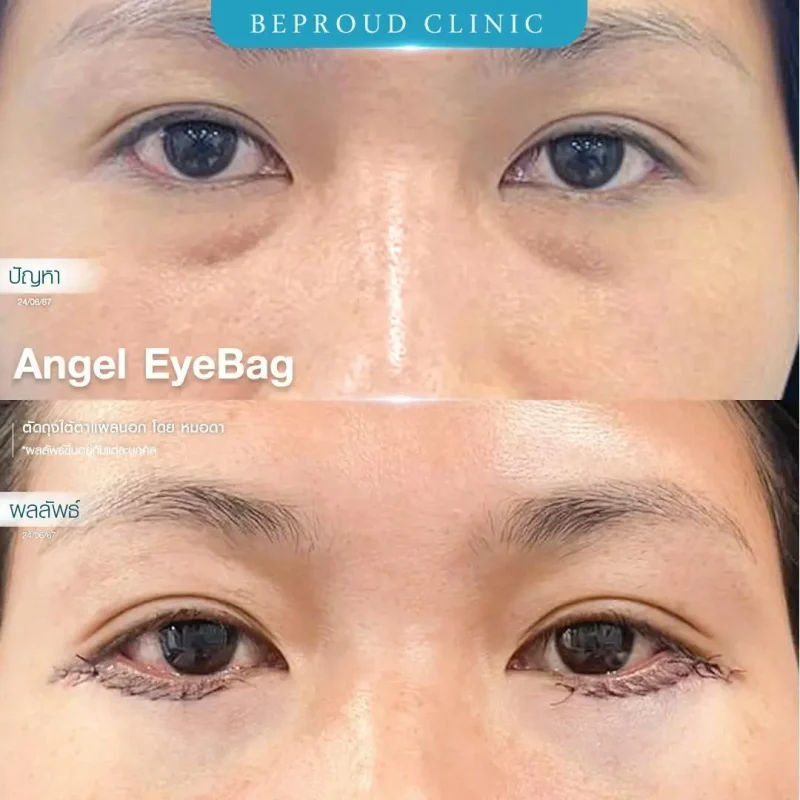 ภาพรีวิวเปรียบเทียบผลลัพธ์ ก่อนทำ-หลังทำศัลยกรรมตัดถุงใต้ตาแผลนอก โดยหมอดา บีพราวด์คลินิก