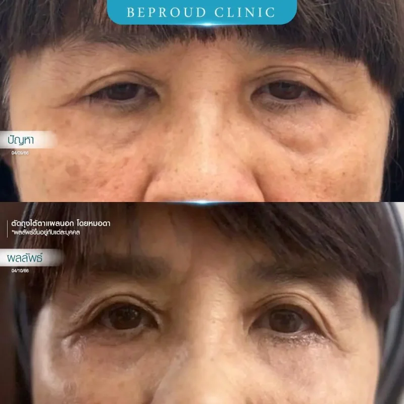ภาพรีวิวเปรียบเทียบผลลัพธ์ ก่อนทำ-หลังทำศัลยกรรมตัดถุงใต้ตาแผลนอก โดยหมอดา บีพราวด์คลินิก