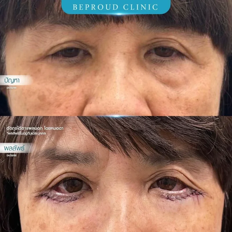 ภาพรีวิวเปรียบเทียบผลลัพธ์ ก่อนทำ-หลังทำศัลยกรรมตัดถุงใต้ตาแผลนอก โดยหมอดา บีพราวด์คลินิก