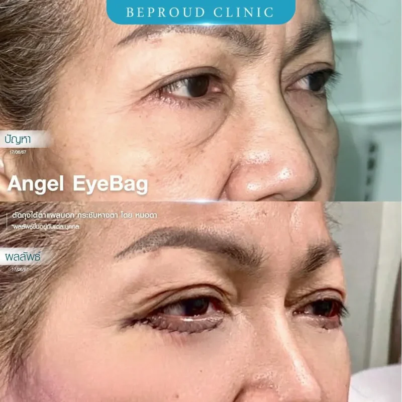 ภาพรีวิวเปรียบเทียบผลลัพธ์ ก่อนทำ-หลังทำศัลยกรรมตัดถุงใต้ตาแผลนอก กระชับหางตา โดยหมอดา บีพราวด์คลินิก