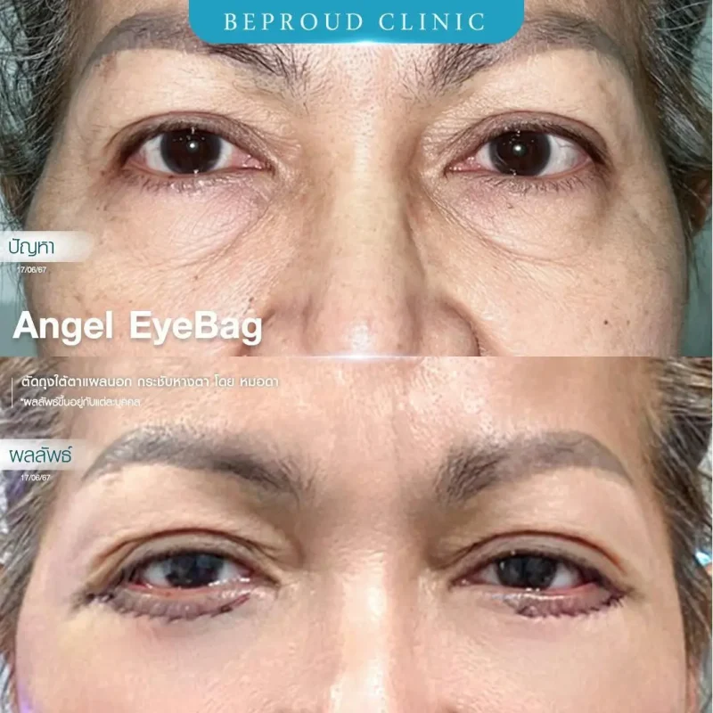 ภาพรีวิวเปรียบเทียบผลลัพธ์ ก่อนทำ-หลังทำศัลยกรรมตัดถุงใต้ตาแผลนอก กระชับหางตา โดยหมอดา บีพราวด์คลินิก
