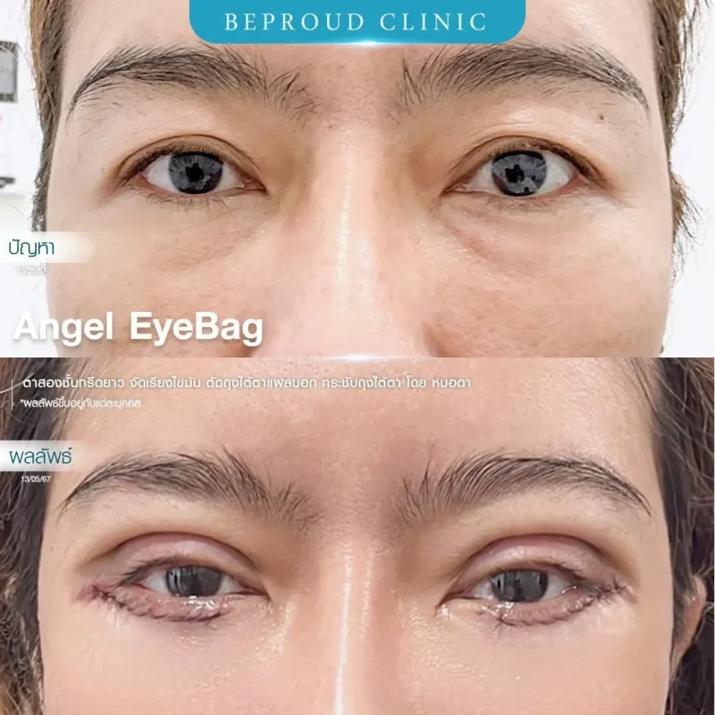 ภาพรีวิวเปรียบเทียบผลลัพธ์ ก่อนทำ-หลังทำศัลยกรรมตาสองชั้น ของเคสตัวอย่าง เทคนิคกรีดตายาว จัดเรียงไขมัน ตัดถุงใต้ตาแผลนอก กระชับถุงใต้ตา โดยหมอดา บีพราวด์คลินิก