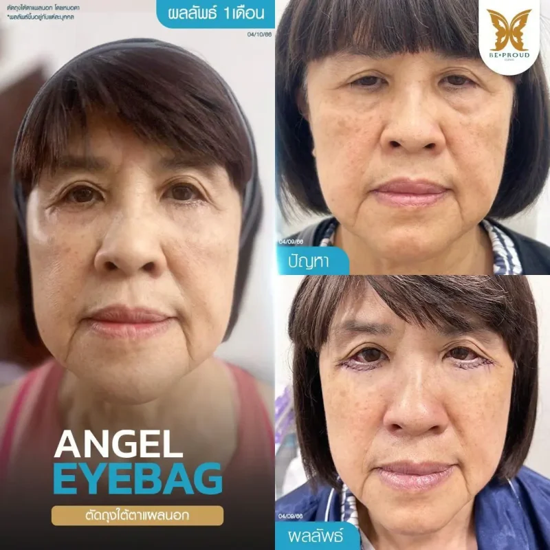 ภาพรีวิวเปรียบเทียบผลลัพธ์ ก่อนทำ-หลังทำศัลยกรรมตัดถุงใต้ตาแผลนอก โดยหมอดา บีพราวด์คลินิก